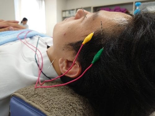 【鍼灸学科】実技授業　頭痛治療